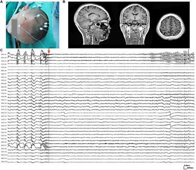 Identifying the Epileptogenic Zone With the Relative Strength of High-Frequency Oscillation: A Stereoelectroencephalography Study